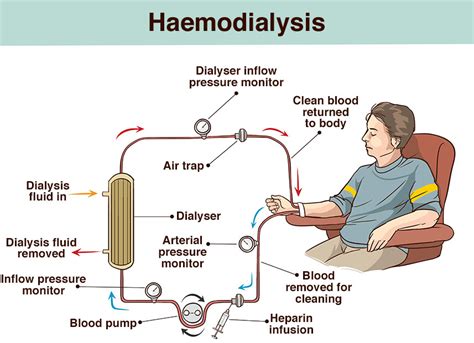 Kidney Disease & Dialysis Treatments .